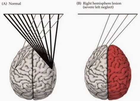 sindrome de heminegligencia cuando la mitad deja de existir 2 | Neurita